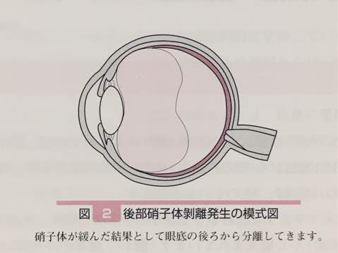 硝子体が網膜から離れていく図／『眼科ケア　2005年冬季増刊』メディカ出版、2006年、p204より