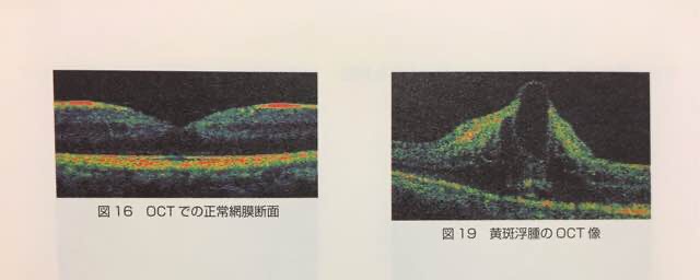 光干渉断層計（OCT）で見た網膜の断面図。黄斑浮腫では隙間に水分が入り込んで断面が凸凹になっている。(図2）