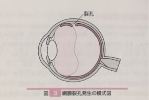 「網膜裂孔」の図解／『眼科ケア　2005年冬季増刊』メディカ出版、2006年、p205より