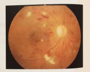 糖尿病網膜症の眼底写真：虚血性の白斑が出現、ハケ状の出血が点々と見られる（図4）（図4）